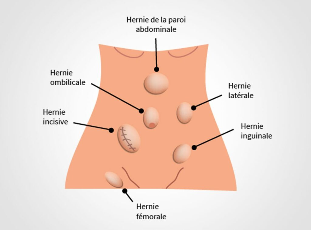 Hernies Et Chirurgie Digestive Paris Dr Servajean