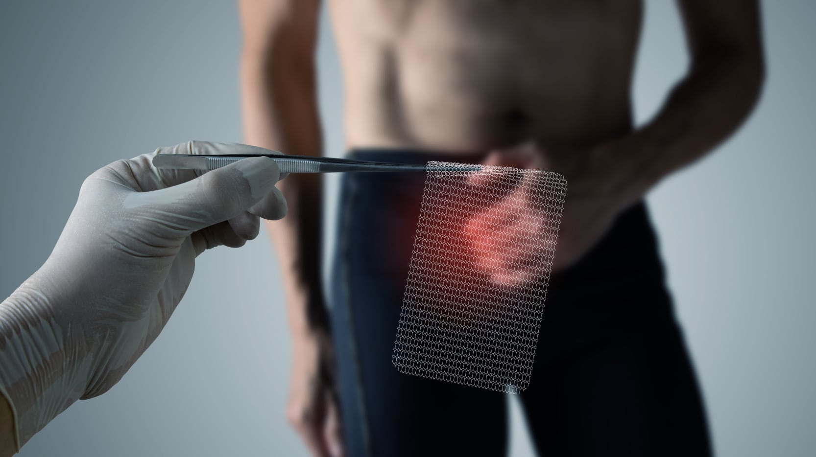 chirurgie mini invasive hernies quels avantages | Dr Servajean | Paris